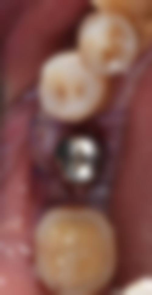 北京牙元素口腔：种植牙实惠之选