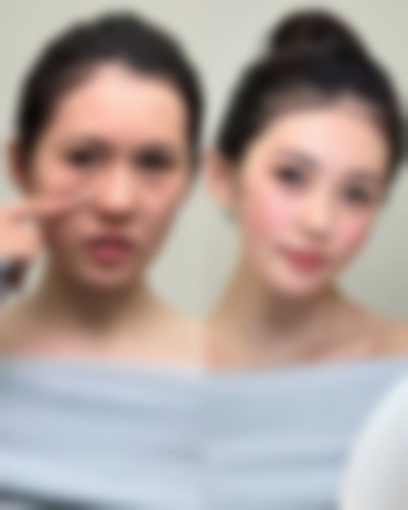 深圳恒泽医疗整形美容医院的王牌项目:鼻头缩小手术详解
